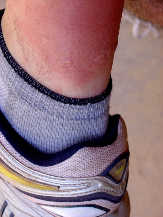 Hiker's rash red rash between knee and ankle after hiking for several