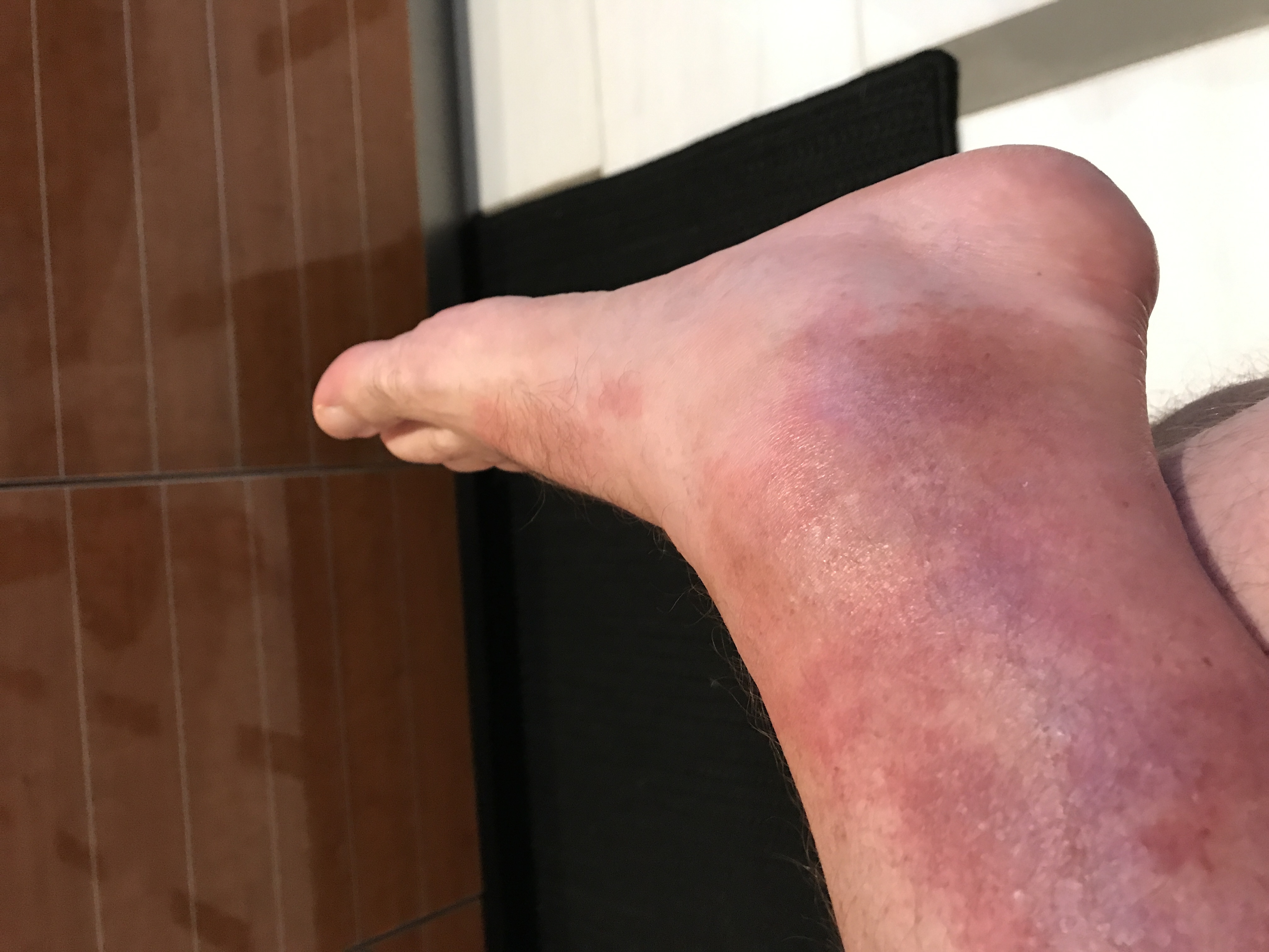 hiker-s-rash-red-rash-between-knee-and-ankle-after-hiking-for-several